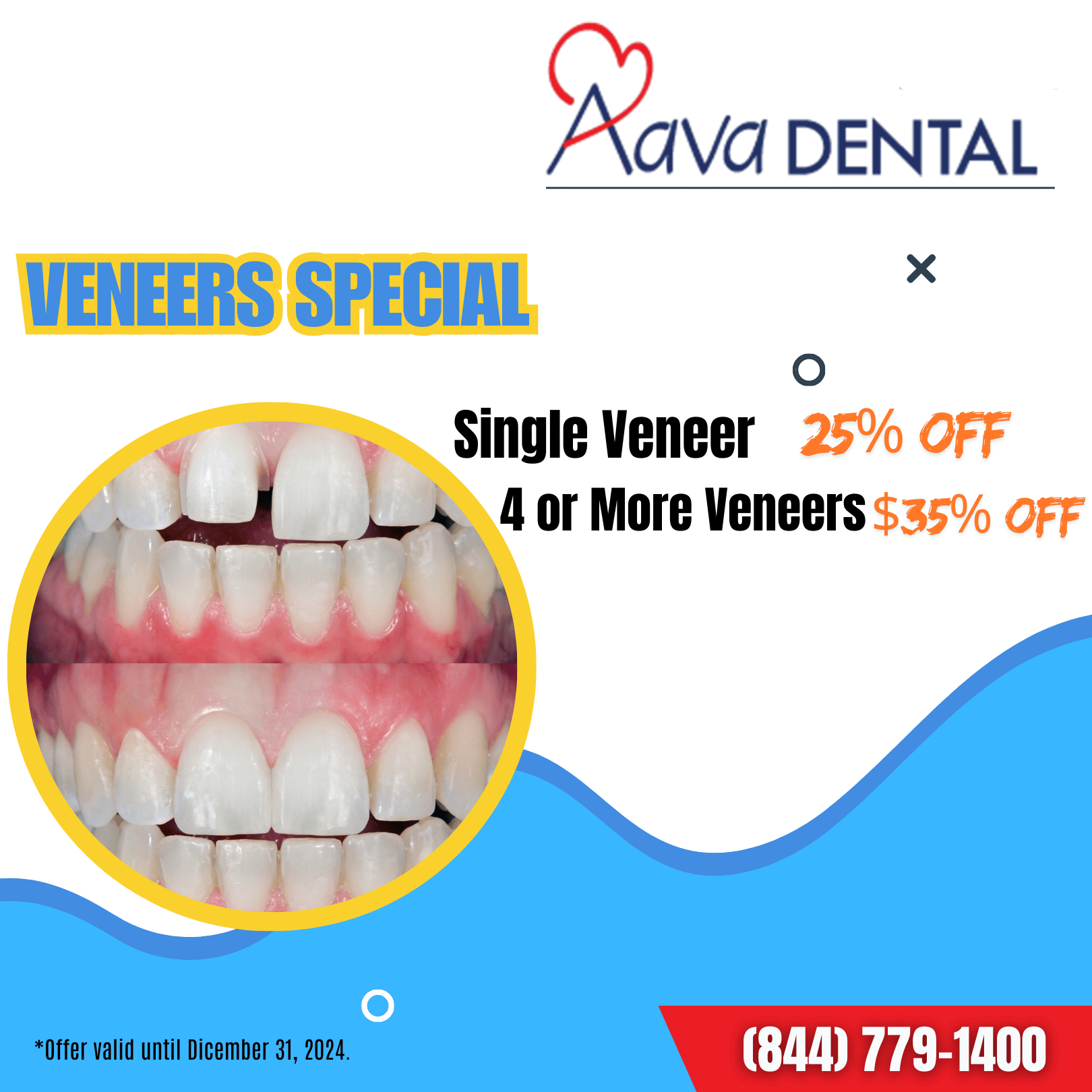 Veneers specials